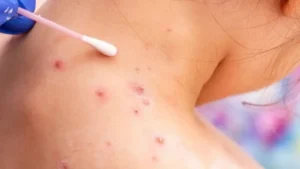 Salud Pública notifica dos nuevos casos de Viruela Símica; totalizan nueve en lo que va de año
