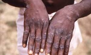 Temen haitianos tengan viruela del mono en Yerbabuena de Hato Mayor
