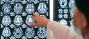 Más de 50 millones de personas padecen epilepsia en todo el mundo 