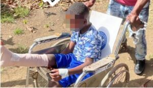 Tras reporte de CDN, operan con éxito niño que sufrió accidente en Hato Mayor