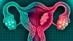 El país registra 700 muertes y 1,074 nuevos diagnósticos por cáncer de cuello uterino


