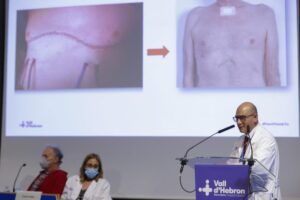 Los trasplantes de pulmón son cirugías agresivas porque obligan a hacer una incisión en gran parte del pecho y romper las costillas, con el fin de poder llegar a los órganos.

Para tratar de evitar esta situación, Vall d’Hebron creó «una técnica nueva, mínimamente invasiva, para no abrir el tórax ni el esternón como si fuera el capó del coche”, resaltó Jauregui.

Esta nueva técnica consiste en hacer «una incisión pequeña por debajo del esternón, sin romper las costillas, por donde entra y sale el pulmón», explicó.