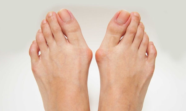 Cuidado de los pies | Juanetes, ¿Cómo tratarlos?
