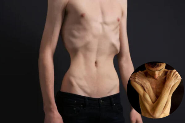 Hombre con anorexia. Foto: CDN digital 