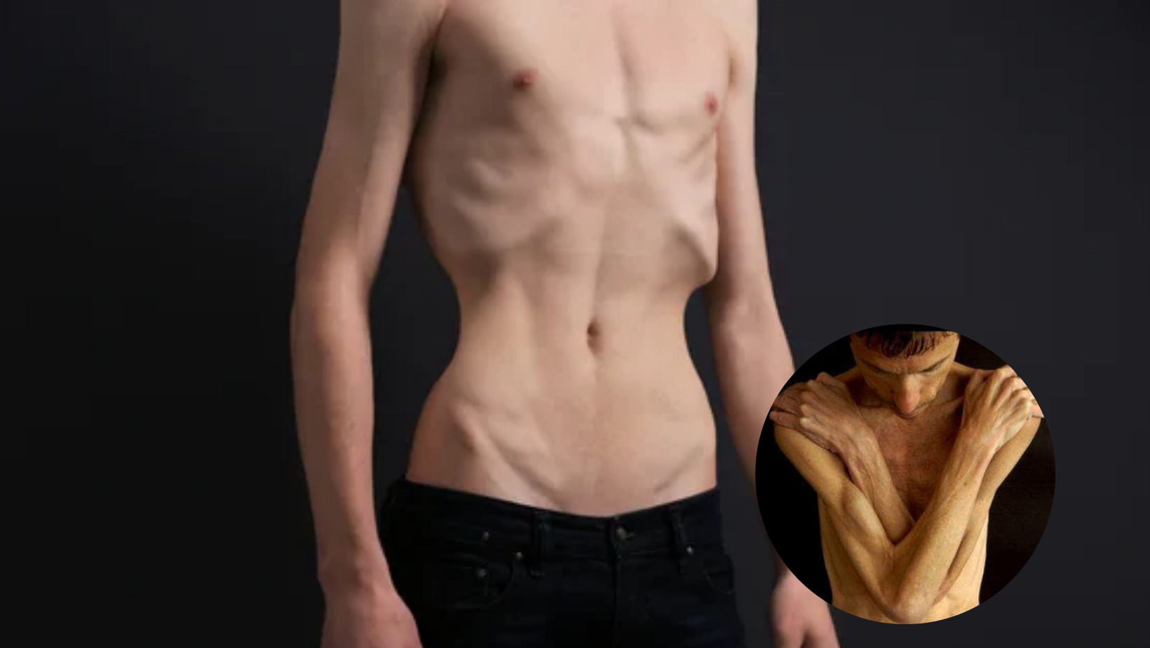 Anorexia afecta a niños y hombres, según estudio