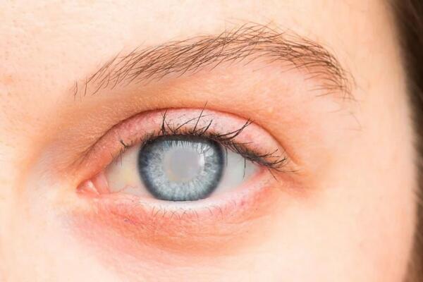 Glaucoma, la enfermedad silenciosa (Foto: fuente externa)