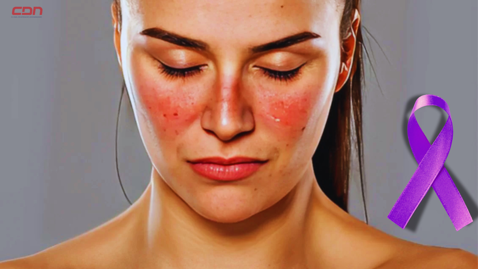 Una persona con Lupus