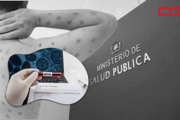 viruela símica (viruela del mono)