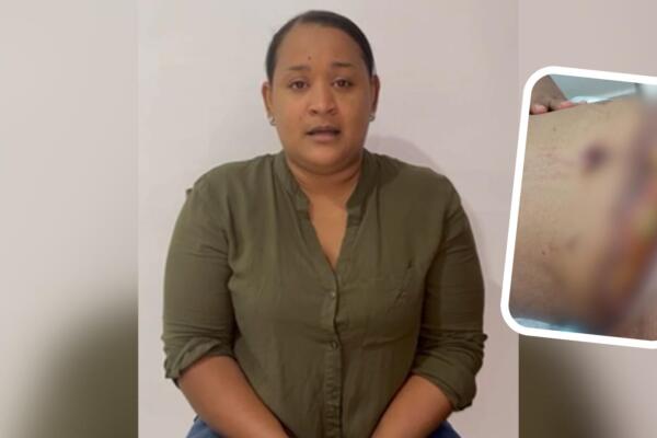 Iliana Carolina Espinal Marte, quien denunció cirujano por mala práctica en cirugía estética 