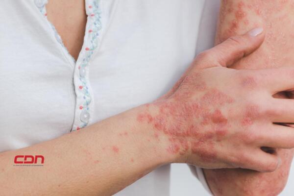 Hoy es Día Mundial de la Psoriasis.(foto, fuente externa)
