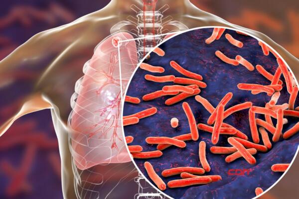Ministerio de Salud asegura no hay riesgo de brote de tuberculosis en el país.(foto, fuente externa)