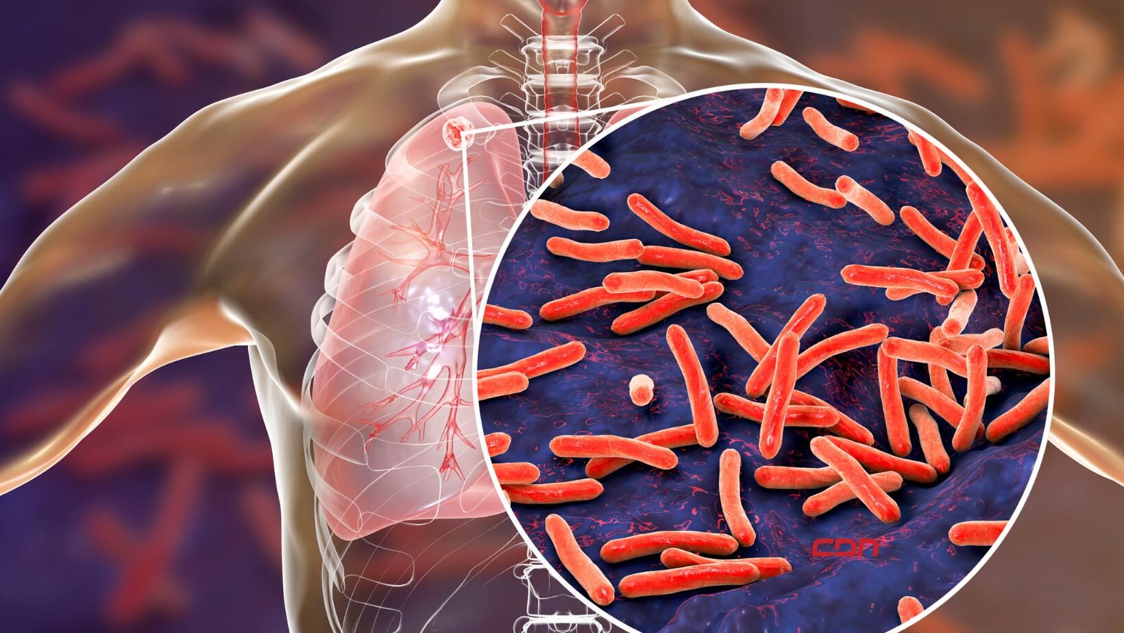 tuberculosis