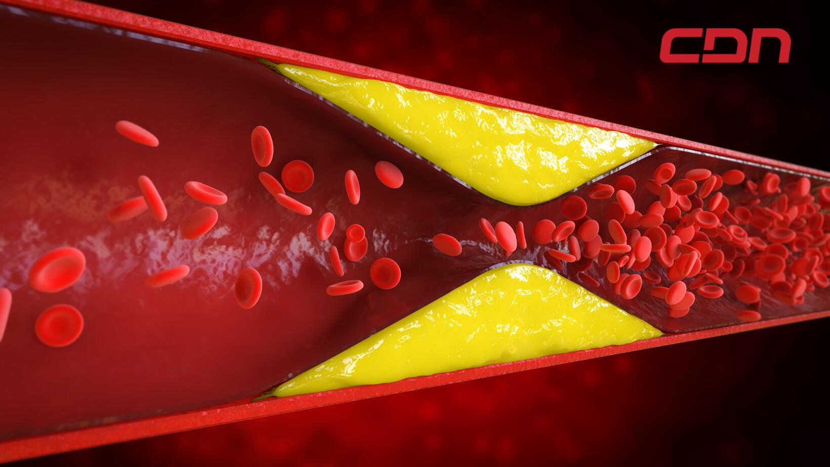 Coágulos de sangre, un problema silencioso que puede ser peligroso