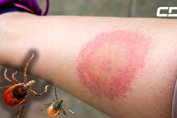 Enfermedad de Lyme: síntomas, causas y prevención