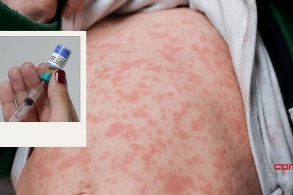Luego de entrar al cuerpo, el sarampión se aloja principalmente en las vías respiratorias y desde allí afecta a los demás órganos. Foto: Fuente externa 
