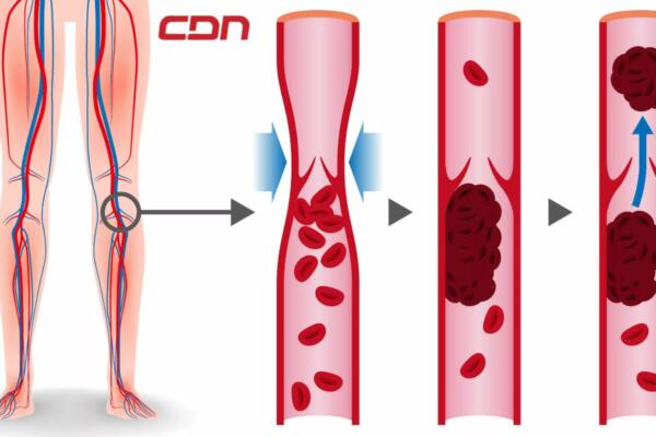 Trombosis venosa profunda: causas, síntomas y tratamiento