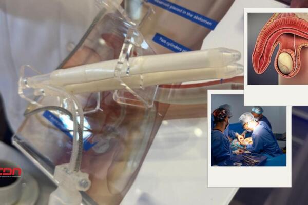 Los implantes de penes son solución médica. Foto:  Fuente externa 