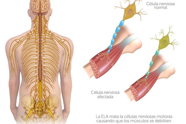 Esclerosis lateral amiotrófica o enfermedad de Lou Gehrig es una enfermedad rara, progresiva y devastadora que afecta el sistema nervioso. Foto: Fuente Externa