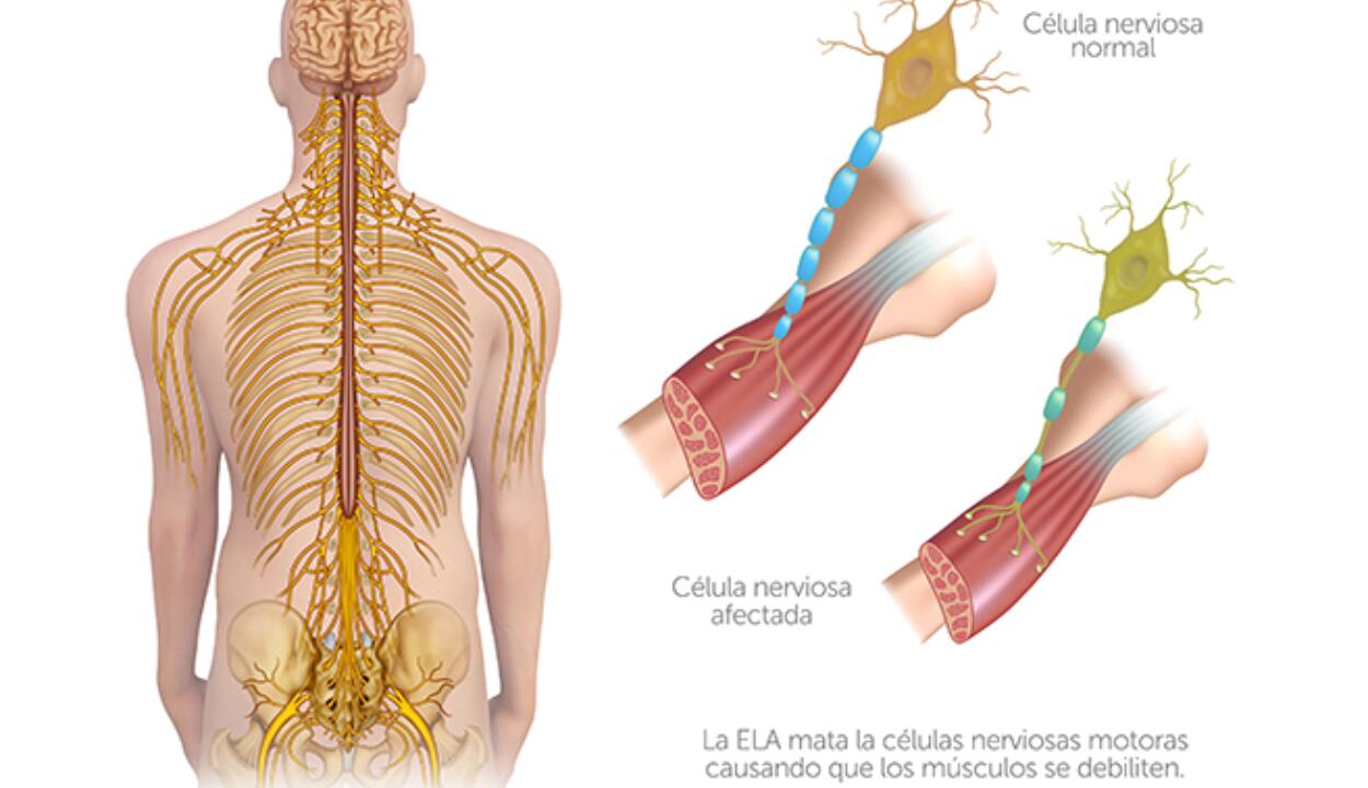 Descubre los síntomas y desafíos de la esclerosis lateral amiotrófica (ELA) o enfermedad de Lou Gehrig