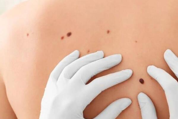 Rayos UV causan el 80% de los melanomas en el mundo, según la OMS.