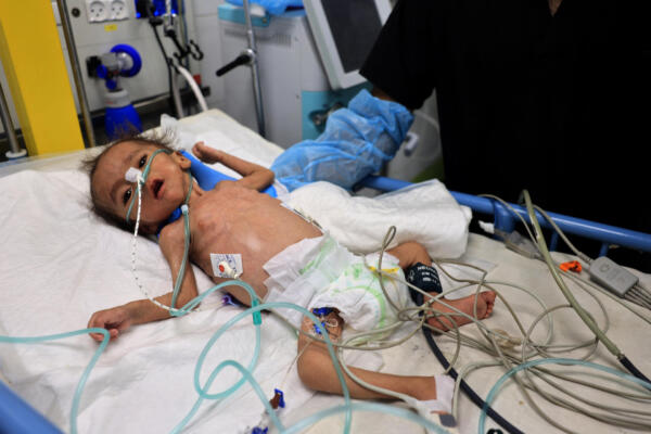 Un niño palestino con desnutrición recibe atención médica en el hospital Nasser de Khan Yunis, al sur de la Franja de Gaza. (Foto de Eyad BABA / AFP)