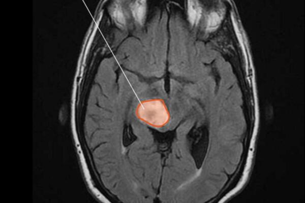 Imagen por resonancia magnética (IRM) de un glioma difuso de línea media en el cerebro. Fuente: Instituto Nacional del Cáncer (NCI) de Estados Unidos.