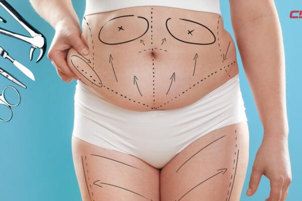 Según registros, la liposcultura es el procedimiento más practicado a nivel mundial, con más de 2 millones de casos.