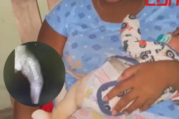 Madre de recién nacido denuncia que médicos no informaron de fractura en pierna del bebé