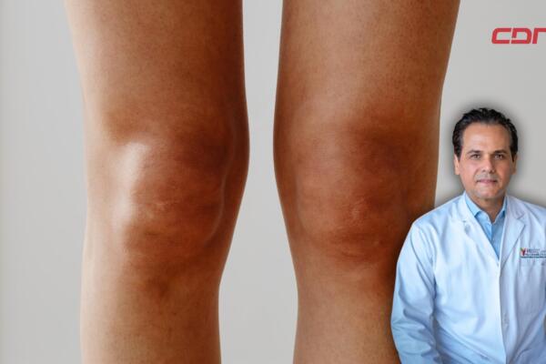 Diferencia de piernas: síntomas, causas y solución.
