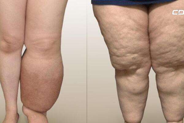 ¿Qué es el lipedema y por qué afecta principalmente a las mujeres?