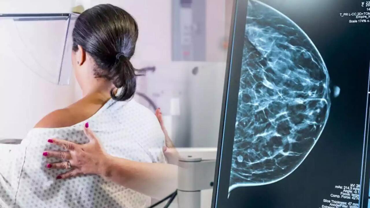cáncer de mama
