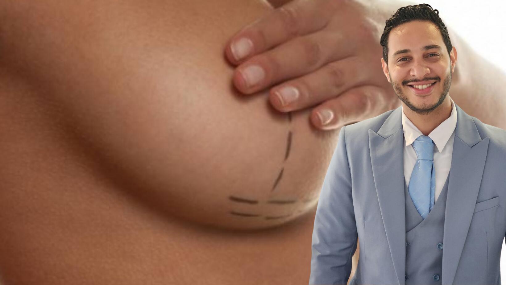 Mamoplastia de reducción