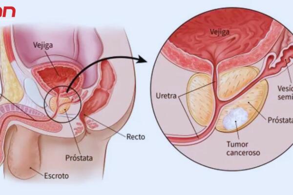 Ilustración anatómica que muestra la próstata y un tumor canceroso. Foto: Fuente externa.