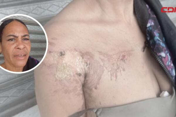 Ataque con aceite hirviendo en Moca deja a joven herida.
