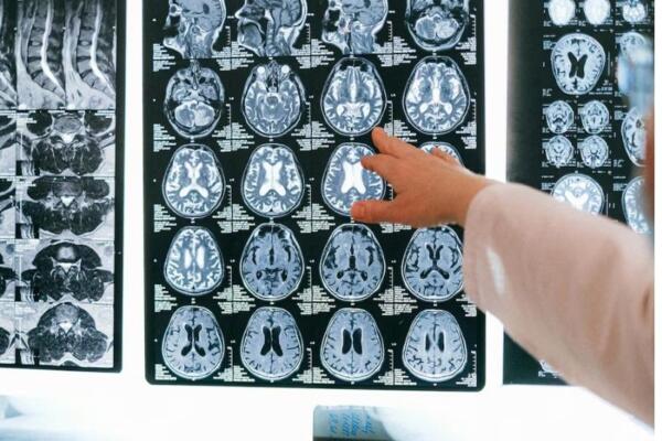 Dos muertos en epidemia de meningitis 