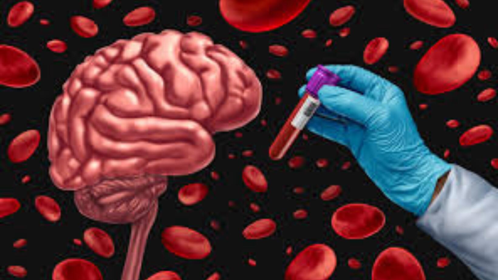 Alzheimer en sangre