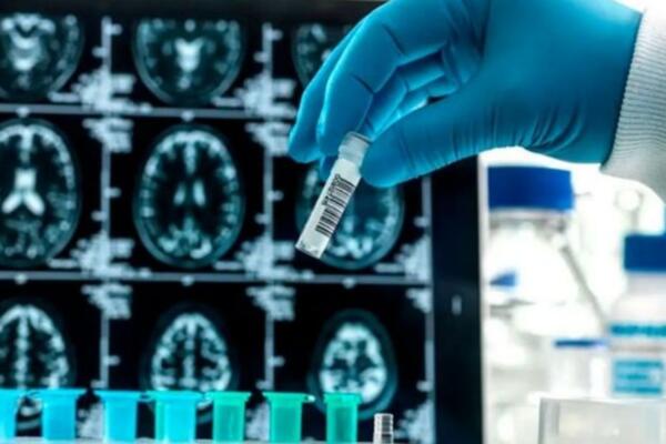 El lecanemab (Leqembi) es un medicamento que se administra para retrasar el avance de la enfermedad de Alzheimer leve.