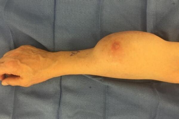 Conozca los síntomas y tratamientos del sarcoma, un cáncer poco frecuente cuyo diagnóstico temprano mejora las posibilidades de curación.