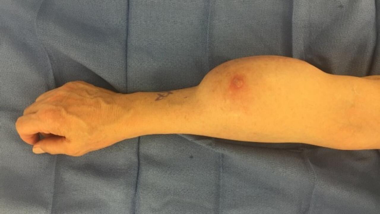 Sarcoma