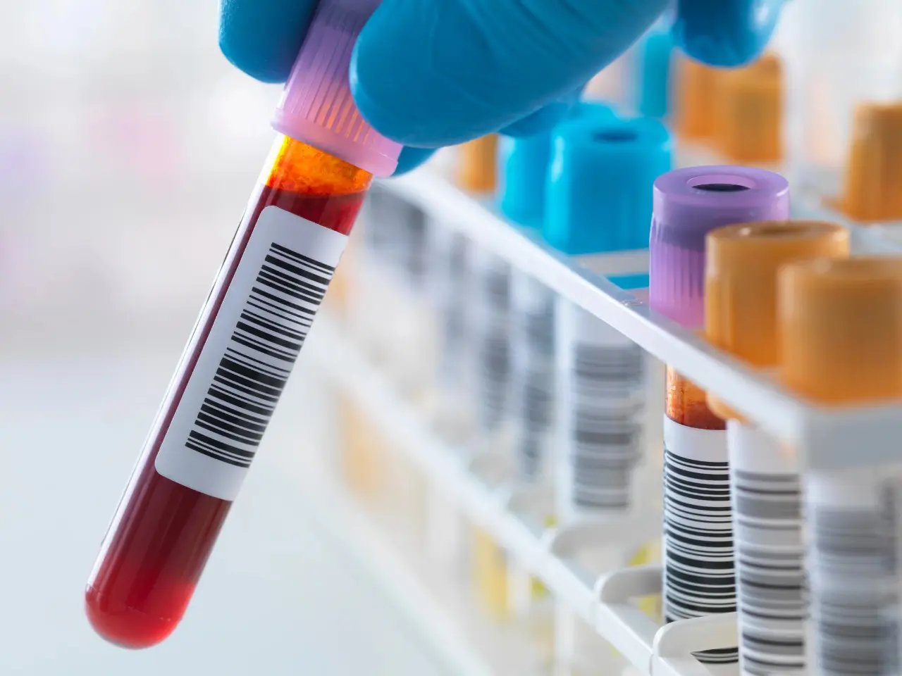 Novedoso análisis de sangre detectaría alzhéimer antes de los síntomas