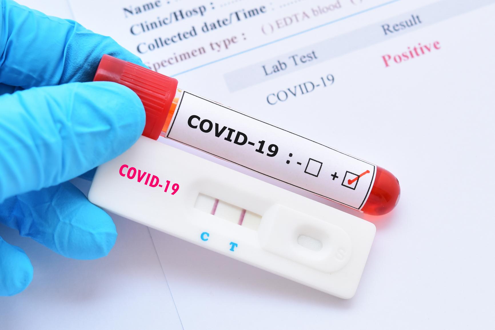 Salud Pública reporta 64 nuevos casos de Covid-19; 350 están activos