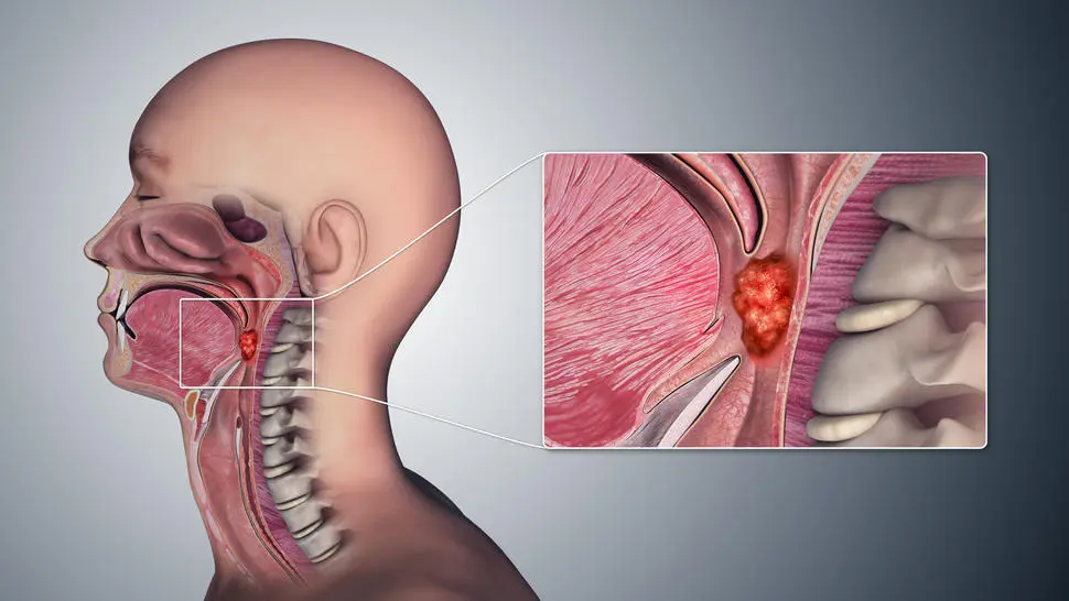 Cáncer de boca y de garganta