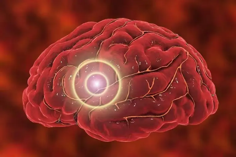 Reducir grasa abdominal podría proteger al cerebro del Alzheimer