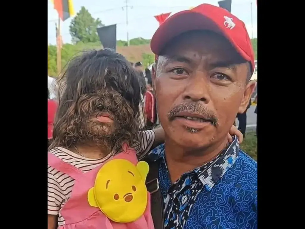 La niña de dos años viral por sufrir el "síndrome del hombre lobo"