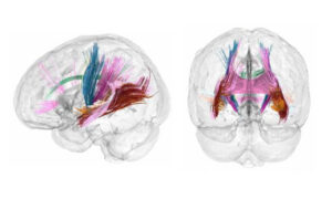 El volumen de materia gris cortical se reduce conforme avanza un embarazo. Los colores más oscuros indican las regiones que más reducen el volumen de materia gris durante la gestación.Crédito: Laura Pritschet