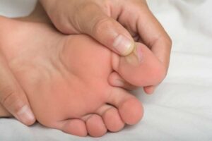 Por qué aparecen ampollas en los pies y cómo prevenirlas