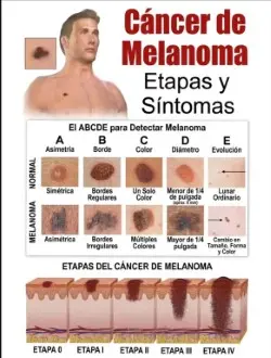 Cáncer de Melanoma