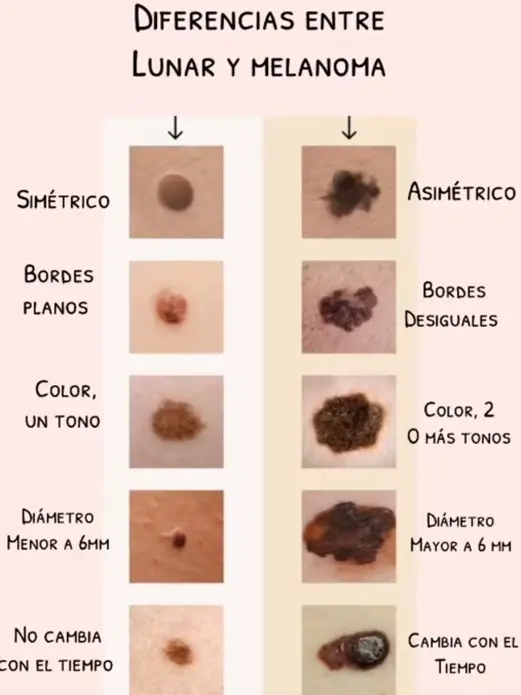 Diferencias entre lunar y melanoma