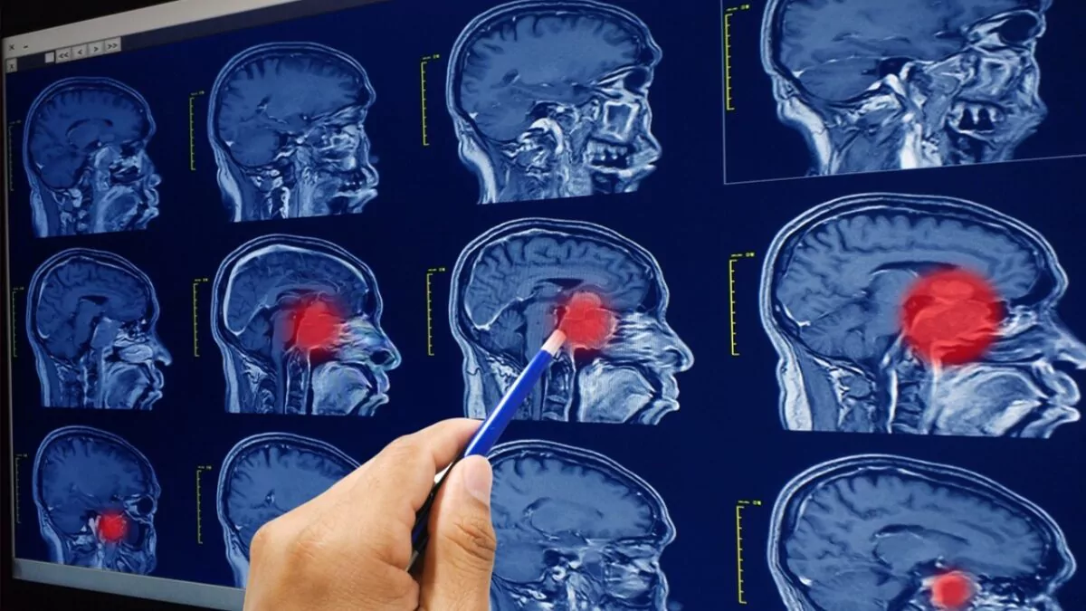 Descubren una vía para combatir la metástasis cerebral
