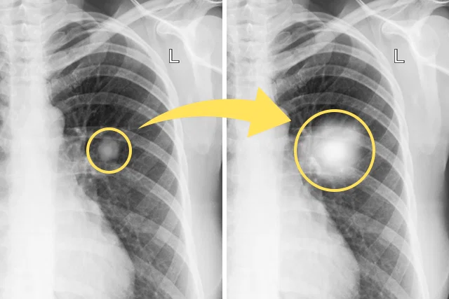Nódulo pulmonar. Fuente externa